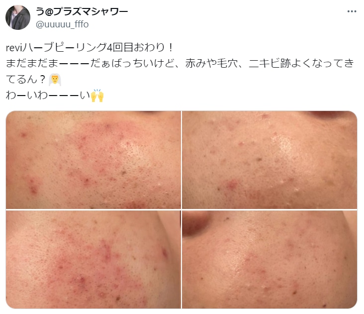 REVI(ルヴィ)ハーブピーリングの効果とは？効果なしと言われる理由や