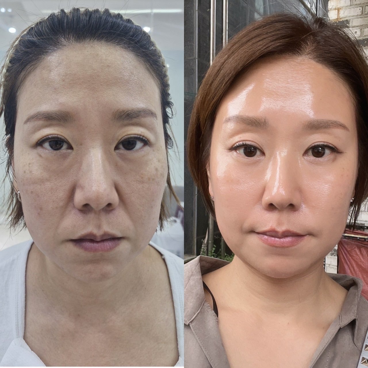 インセルダム症例写真 | incellderm-ICD-整形級コスメインセルダム