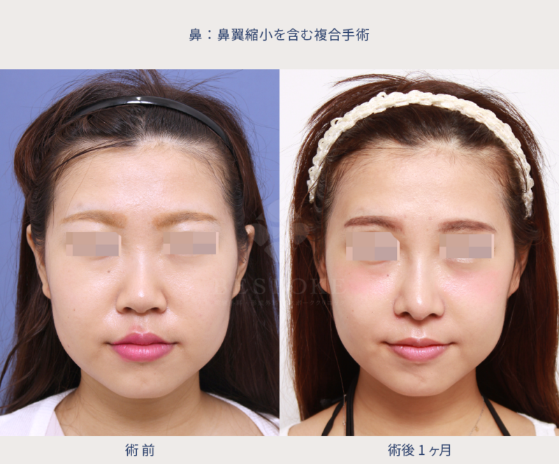 ▷立体感のある顔立ちへ【鼻翼縮小を含む複合手術】 - 福岡 東京渋谷