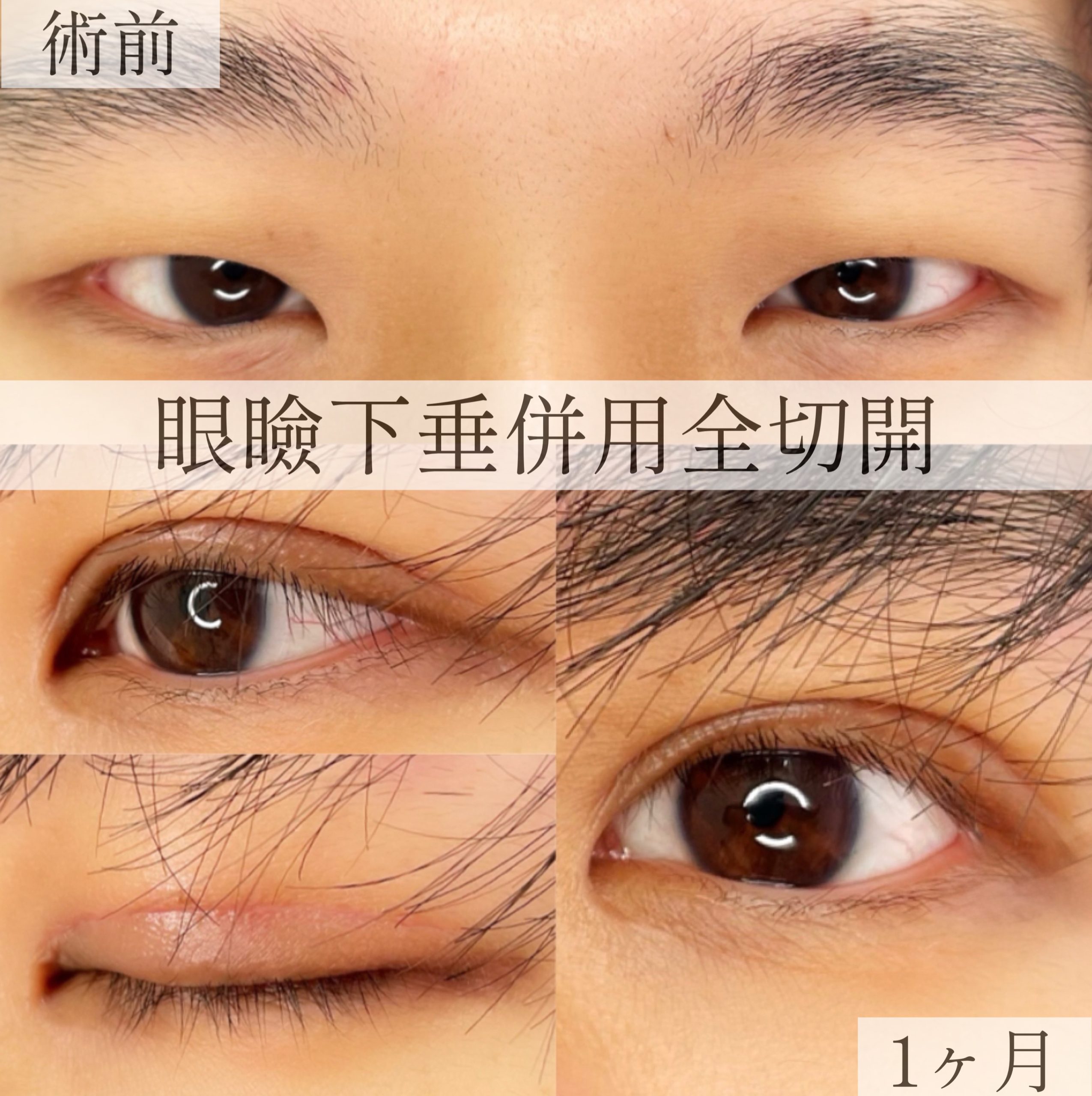 眼瞼下垂手術 | 名古屋の美容外科・美容皮膚科ならCinderella & Da