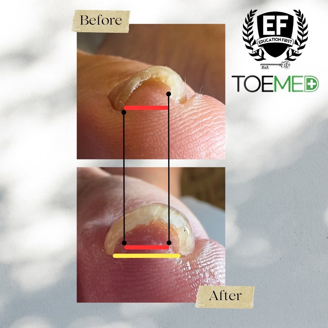 TOEMED 巻き爪ケアジェル 塗るだけで巻き爪ケア出来るジェルTOEMED‼️ | nail ＆ foot care