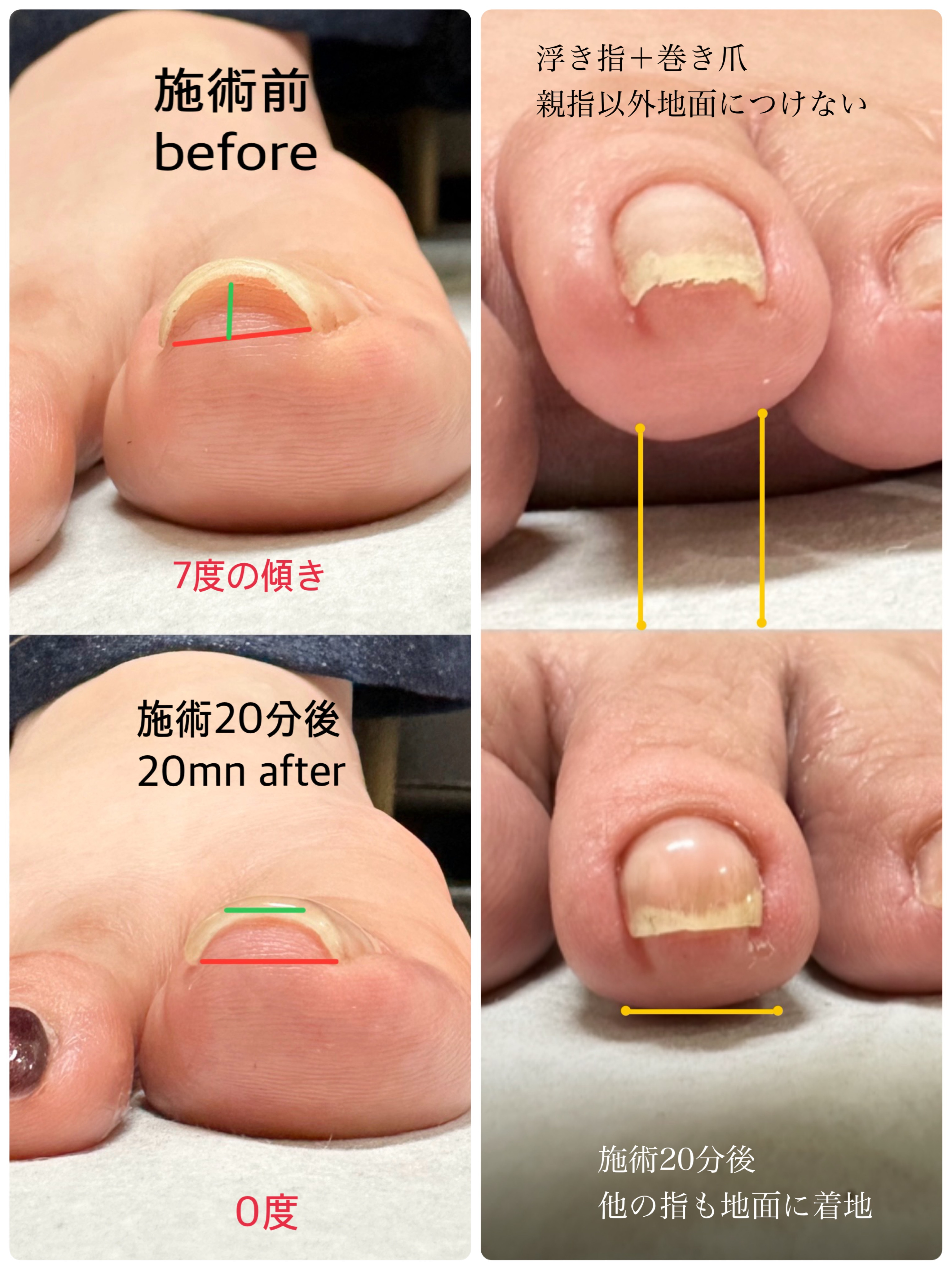 TOEMED 巻き爪ケアジェル 塗るだけで巻き爪ケア出来るジェルTOEMED‼️ | nail ＆ foot care