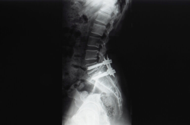 Spinal Endoscopy and Minimally Invasive Spine Surgery Phoenix