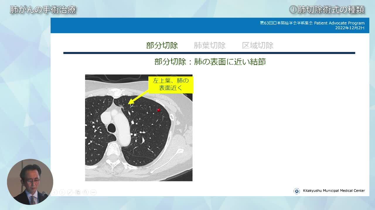 第63回日本肺癌学会学術集会 : 読売新聞オンライン