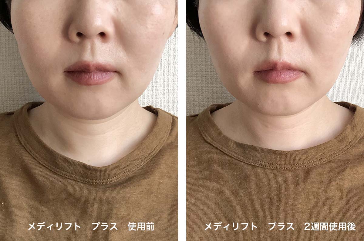 メディリフトプラスの効果は？たるみに悩む30代が2週間使ってみた