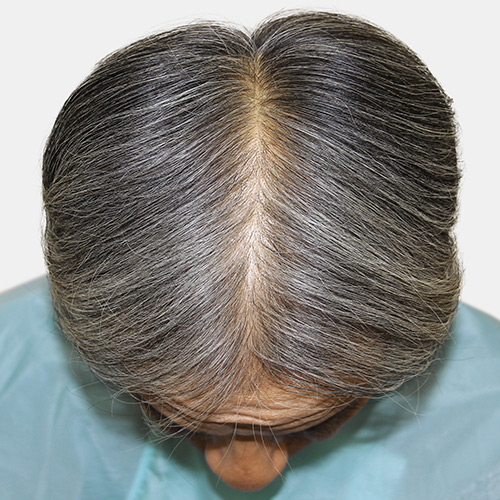 第25回発毛日本一コンテスト｜薄毛改善・発毛専門のリーブ21