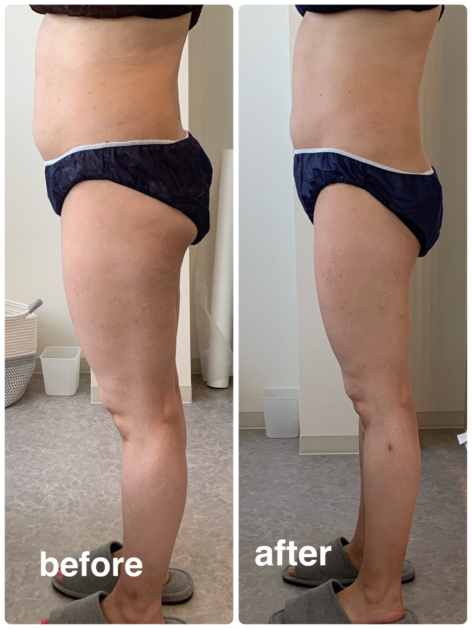 セルライト除去ってこんなに変わるんや( ﾟДﾟ)