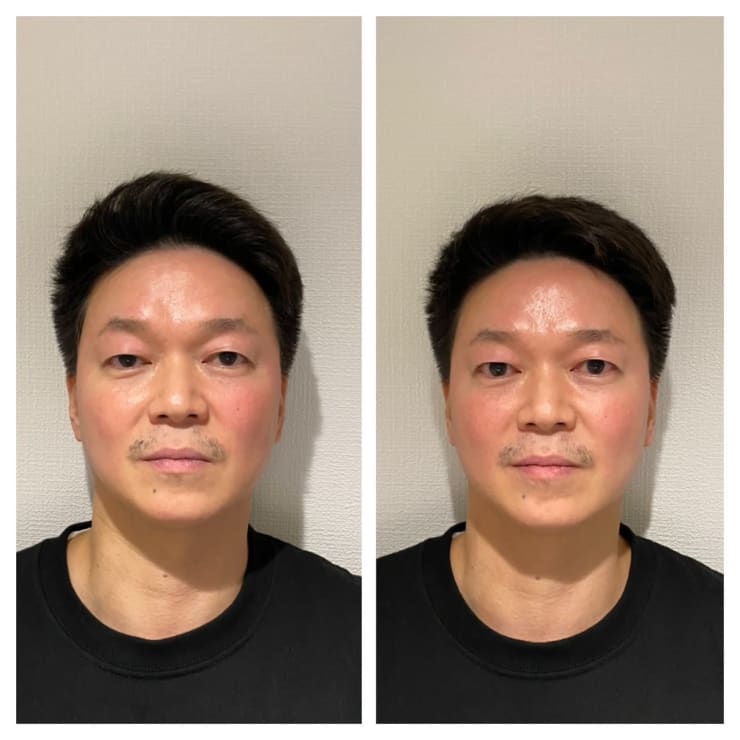 当日予約歓迎》おすすめ♪【フォーカスネオ】二重アゴ、シワ、たるみ