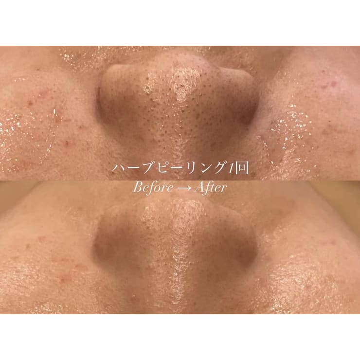 次世代ハーブピーリング！剥離なし！ダウンタイム無し！ | メンズ脱毛