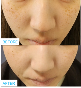 20代女性のそばかす治療 | クララビューティクリニック帯広院