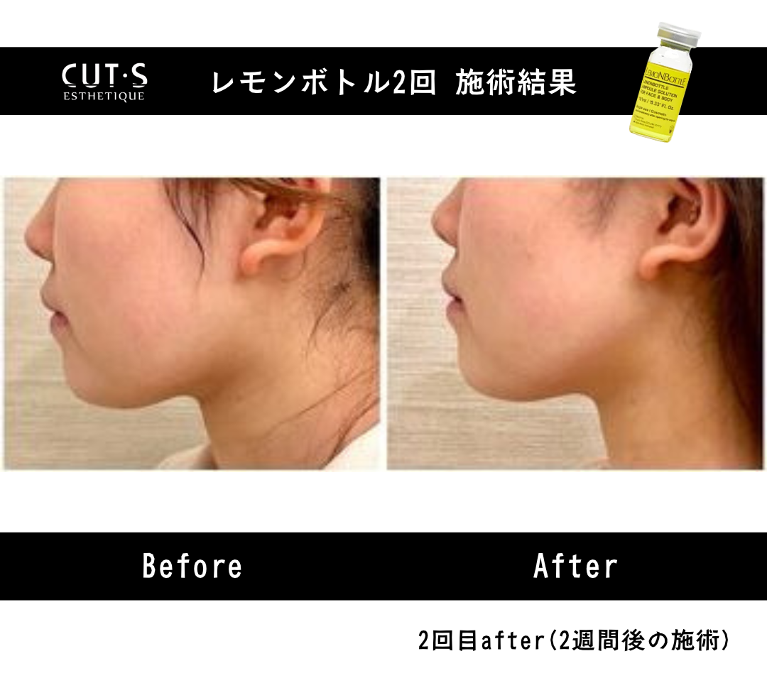 小顔を叶えるリバウンドなしの最新脂肪溶解美容液『レモンボトル
