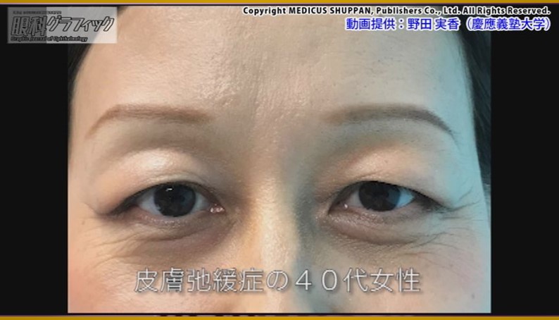 眼科スゴ技 眼瞼手術 WEB動画付き厳選35本｜動画ライブラリ