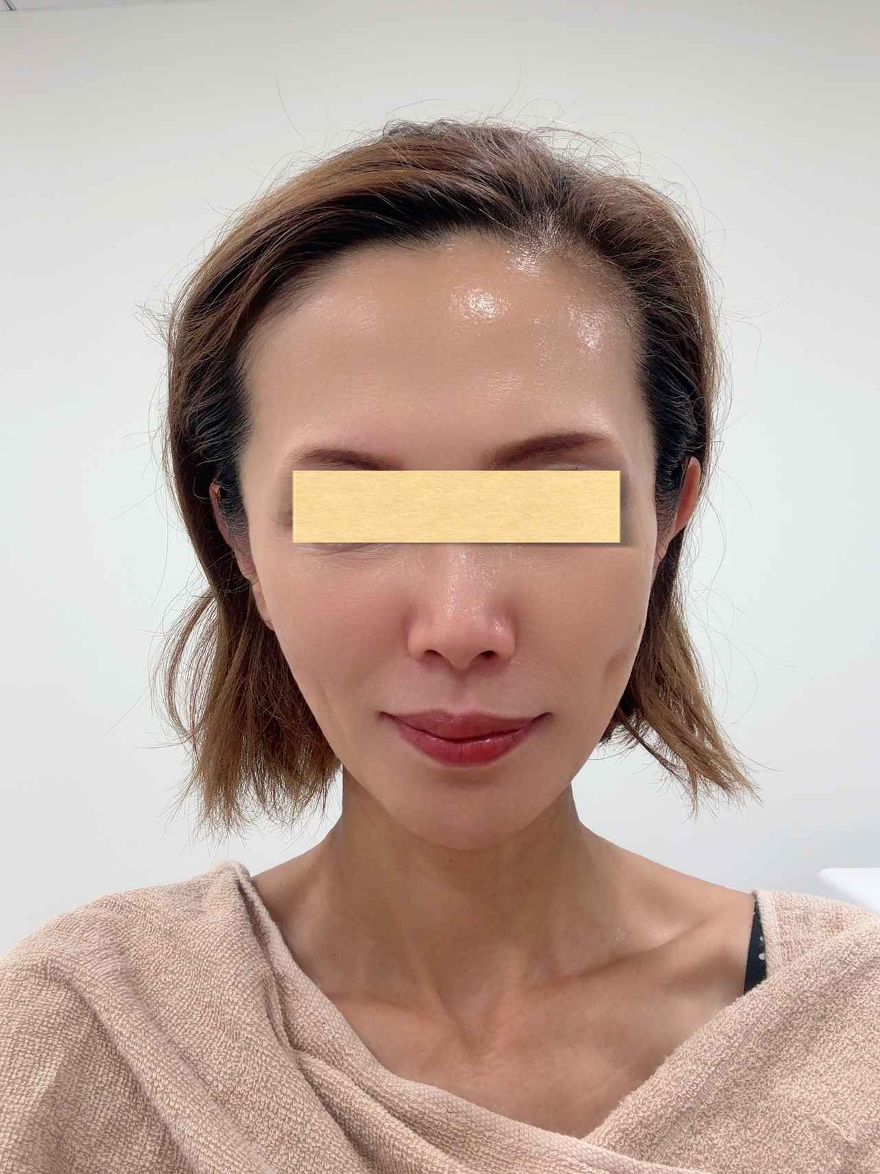 速攻小顔”を実感！針を使わずに美容液を肌の奥深くへ「ディープ