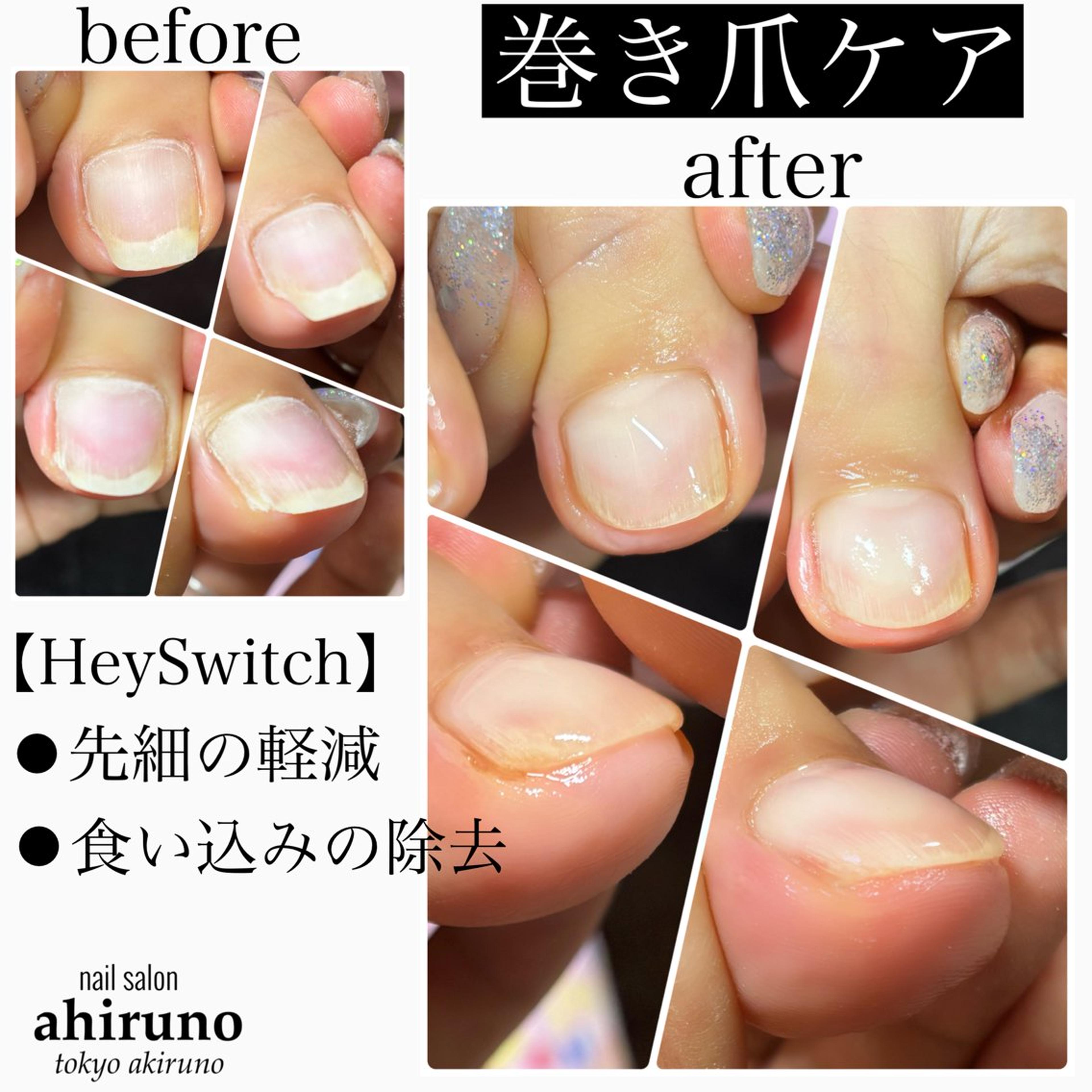 巻き爪ケア 機能性特殊ジェルHey Switch ⇨ヘイスイッチといいます