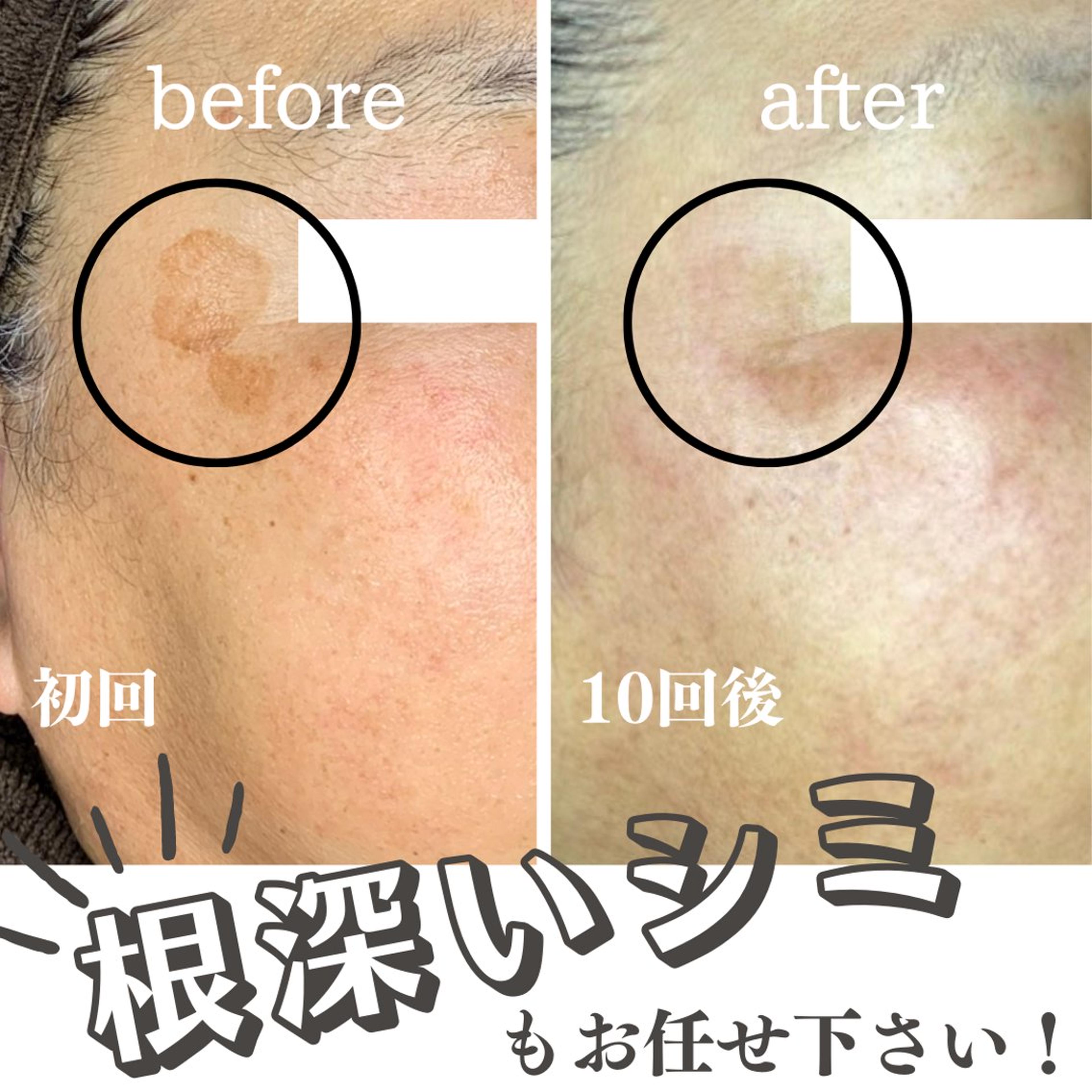 当サロンのシミケア機器は低周波で行う ペンタイプの最新シミケアです