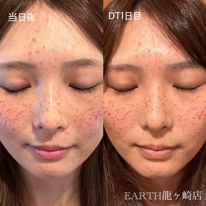 プラズマシャワー️×ハイドラフェイシャルで 毛穴の汚れがごっそり