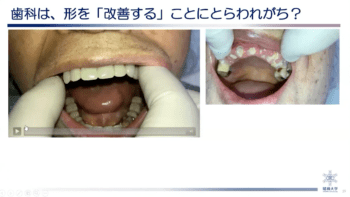 訪問診療における有床義歯治療の基本 – 株式会社デジタルクリエイト