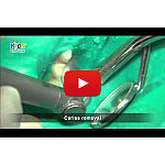 キッズクラウン 乳歯冠 イントロキット｜オンラインカタログ internet