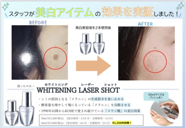Peace インプレアのホワイトニングレーザーショットで気になるシミを