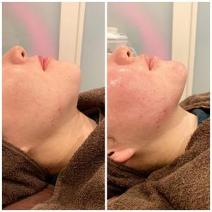 業務用ハイフ】フォーカスネオの効果は？ビフォー・アフターや口コミを