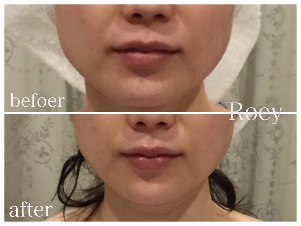 業務用ハイフ】フォーカスネオの効果は？ビフォー・アフターや口コミを