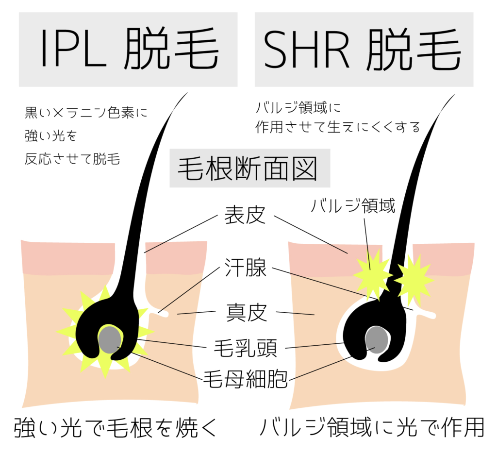 SHR方式の業務用脱毛機まとめ。最新の脱毛方式もご紹介 - 【公式】業務