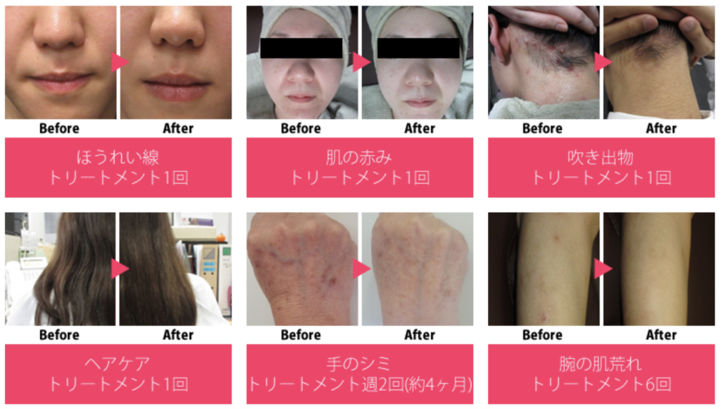 業務用フェイシャル美容機器｜ハイドロインパクトの特徴・効果・価格