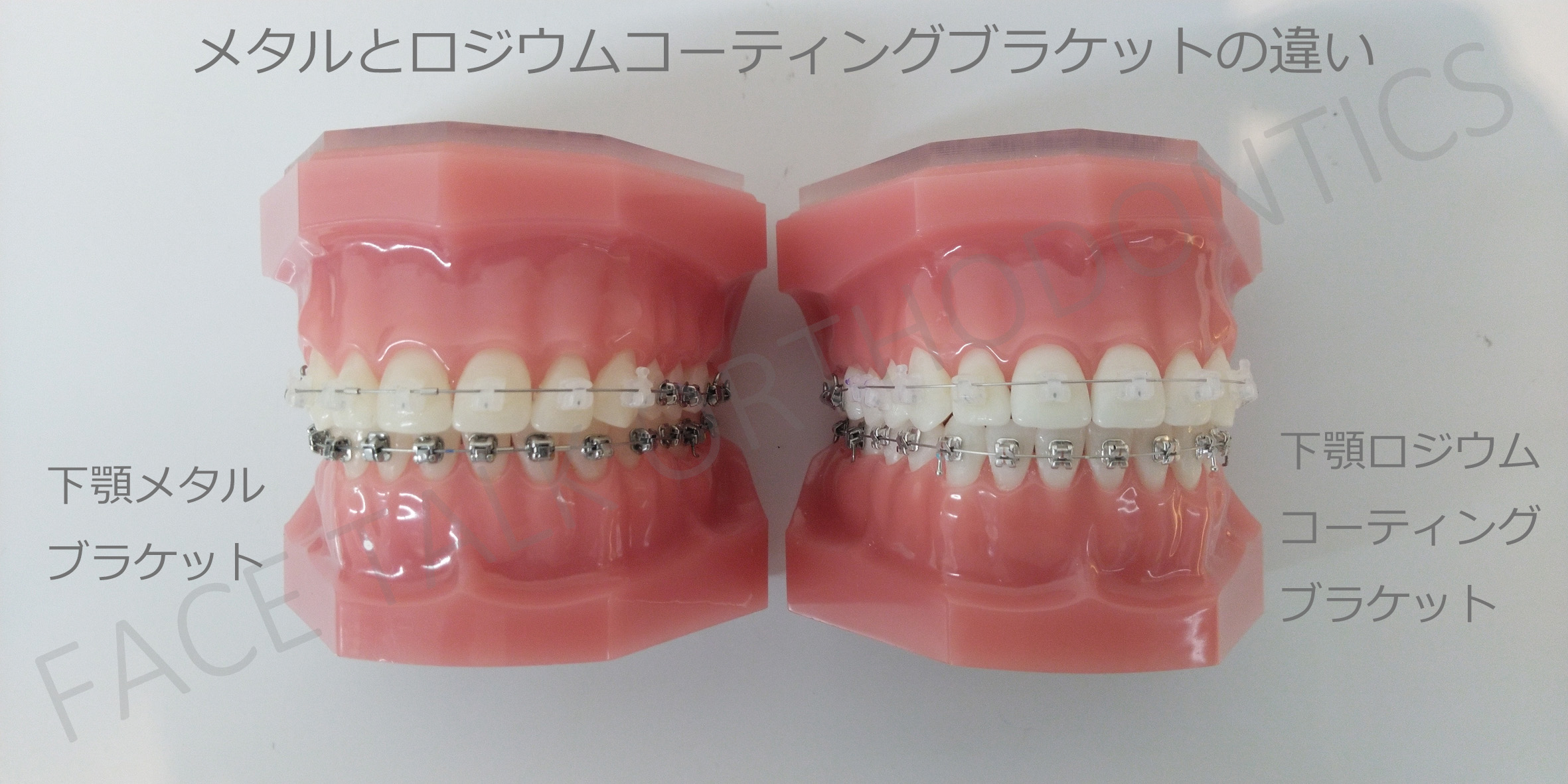 矯正装置（ブラケット）の種類と歯への接着方法について | 医療法人