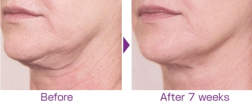 リビジョン ネクティファーム アドバンス（Nectifirm ADVANCED