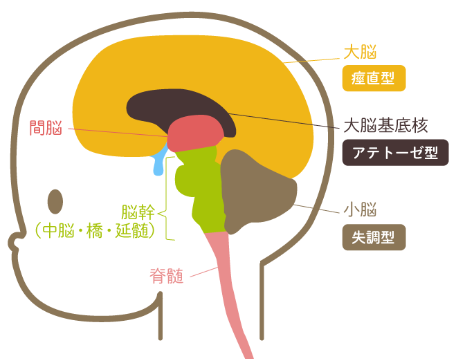 医師監修】脳性麻痺とは？いつ分かる？原因や症状、治療方法、支援制度