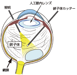 当院の日帰り硝子体手術
