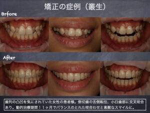 歯列矯正 | 茗荷谷・大人の矯正歯科・審美歯科 小石川 ひとみデンタル