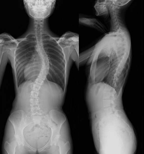 脊椎脊髄センター｜脊柱側弯症治療｜順天堂大学医学部附属順天堂医院