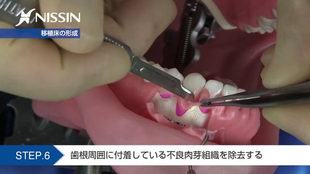 歯周外科ベーシックプログラム | Doctorbook academy (ドクターブック