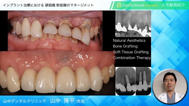 インプラント治療における硬組織、軟組織のマネージメント