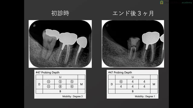 歯内歯周病変（エンドペリオ病変）アドバンスプログラム | Doctorbook