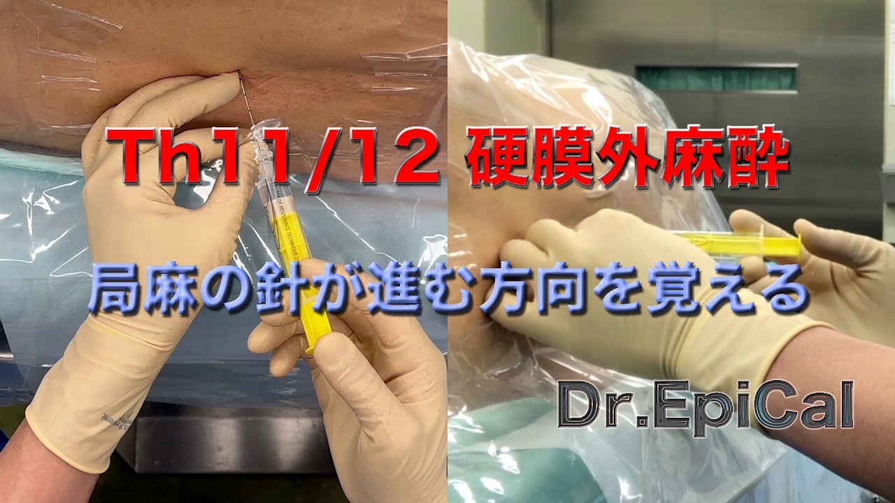 Th11/12 胸部硬膜外麻酔（局麻の針が進む方向を覚える）epidural