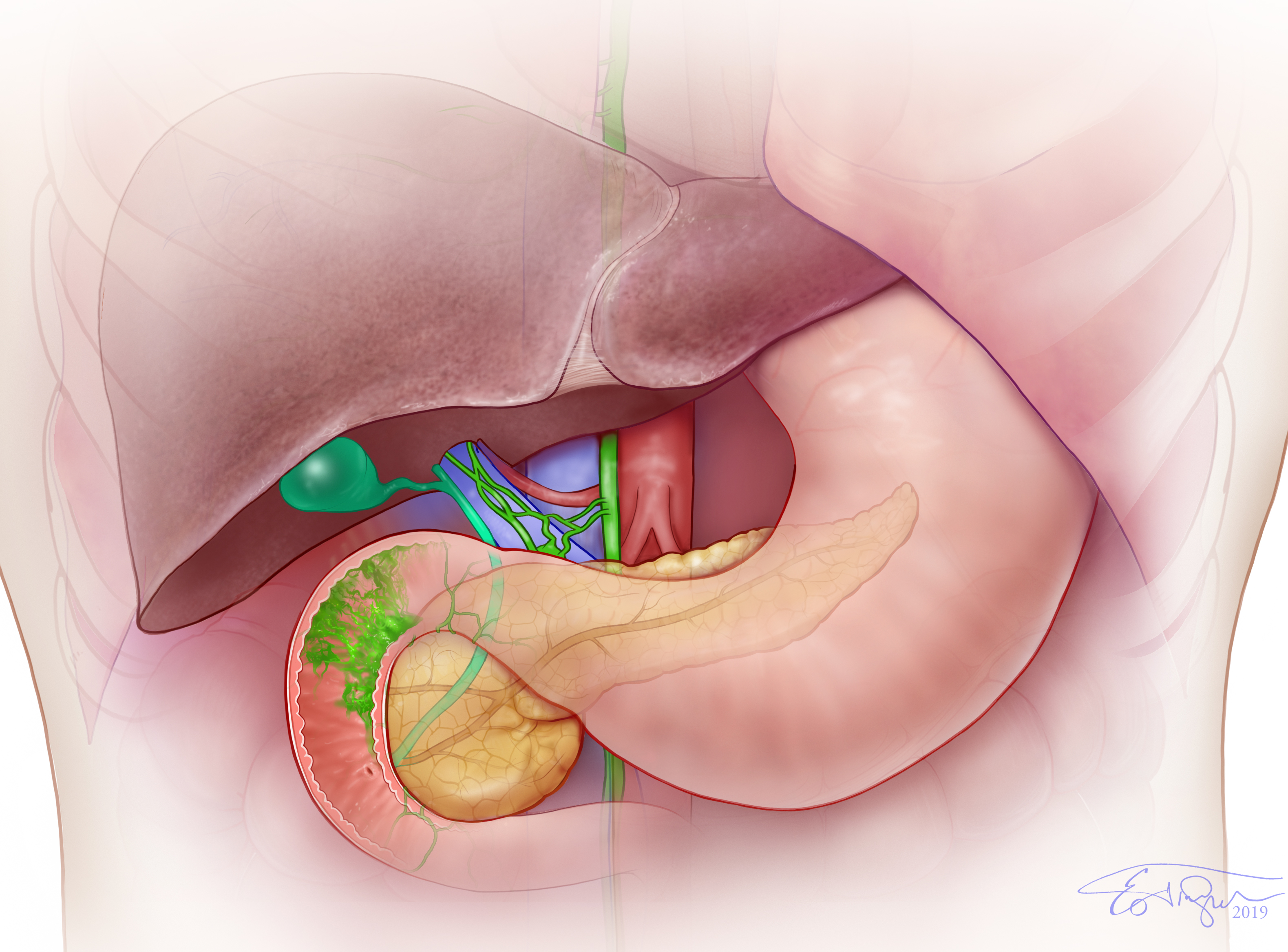 Lymphatic Disorders – Dr. Maxim Itkin, Interventional Radiology