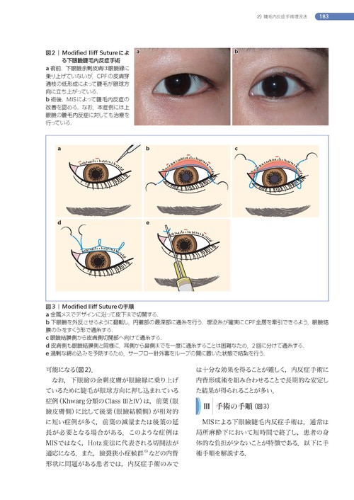 処置室でできる 低侵襲・眼瞼診療 切らない眼科医のアプローチ (新篇