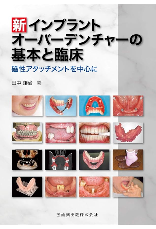 インプラントオーバーデンチャーの臨床とエビデンスQ&A (―インプラント