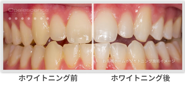 オパールエッセンスGo-過酸化水素6％ ホームホワイトニング材