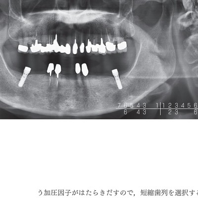 欠損歯列」の読み方,「欠損補綴」の設計
