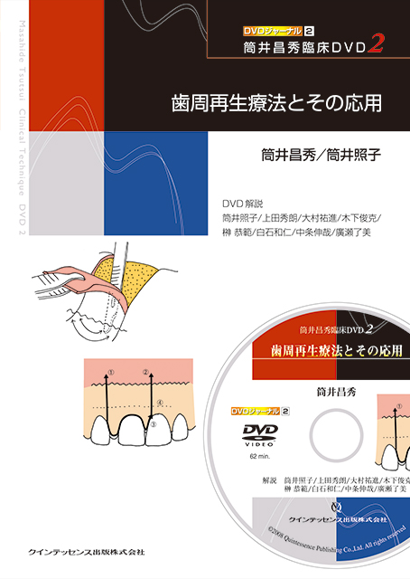 筒井昌秀臨床DVD2 歯周再生療法とその応用 - クインテッセンス出版