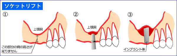 上顎洞挙上術（サイナスリフト・ソケットリフト） - さいたま