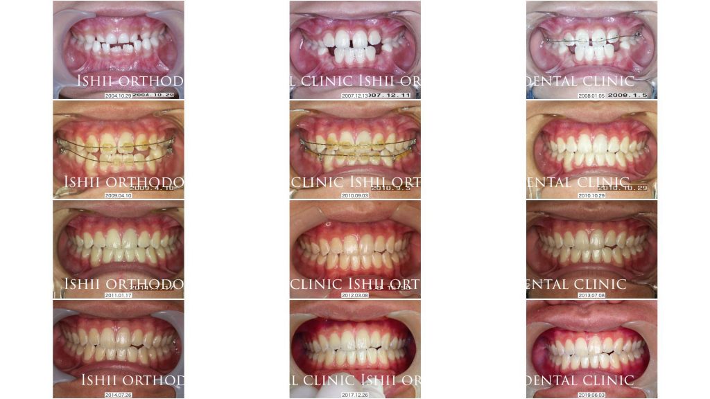 小児矯正1期治療だけで上下顎の成長発育をコントロール album 246