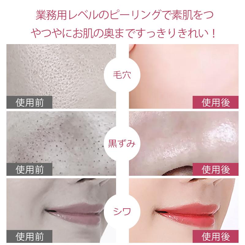 ウォーターピーリング 美顔器 EMS 超音波美顔器 イオン 導入 導出 防水