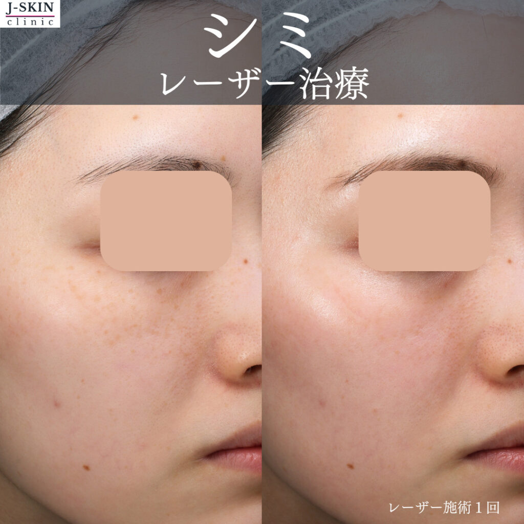 目周りの細かいシミもレーザーにより改善を目指せます - JSKIN