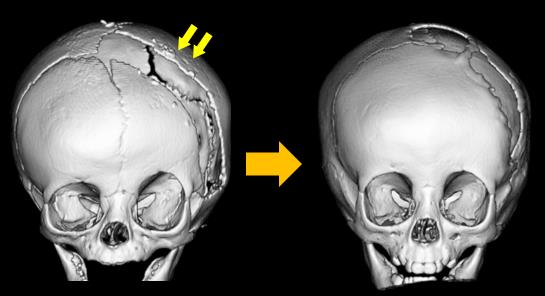 頭蓋縫合早期癒合症