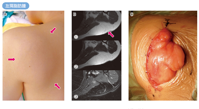 良性軟部腫瘍：| かんテキWeb