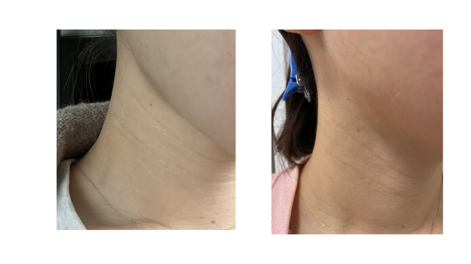 ジャンマリーニ ネッククリーム症例 | 名古屋 金山の美容皮膚科・美容